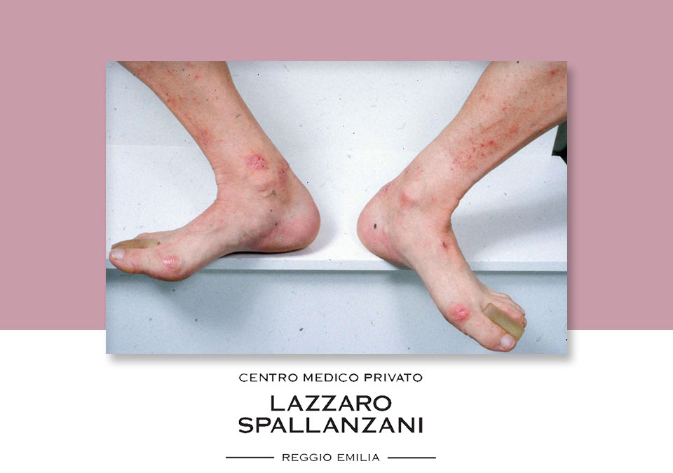 Cura di eczema provviste mediche