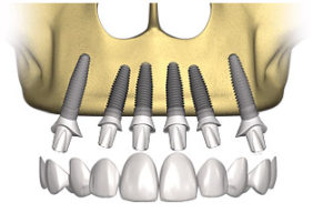 protesi fissa su impianti dentsply computer guidata