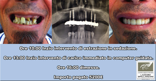 Impianti dentali 24 ore sogno o realtà?