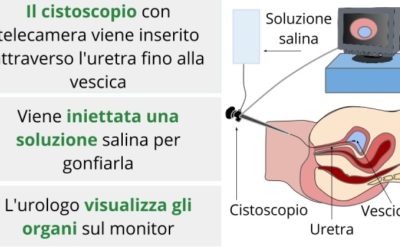 5 casi per i quali è utile una cistoscopia
