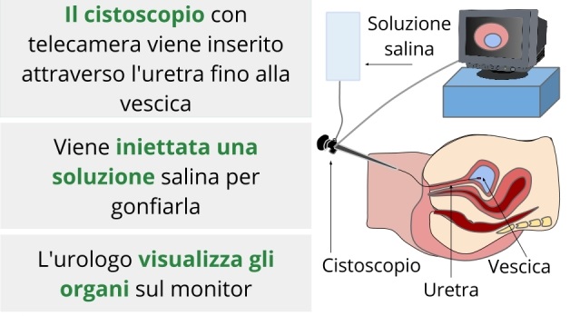 5 casi per i quali è utile una cistoscopia