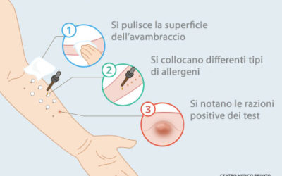 L’efficacia dei test allergici: il Prick Test ed il Patch Test