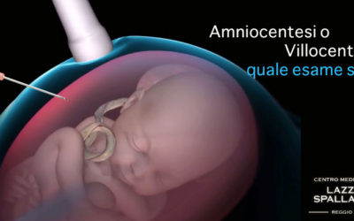 La difficile scelta tra Amniocentesi o Villocentesi