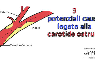 3 potenziali cause legate alla carotide ostruita