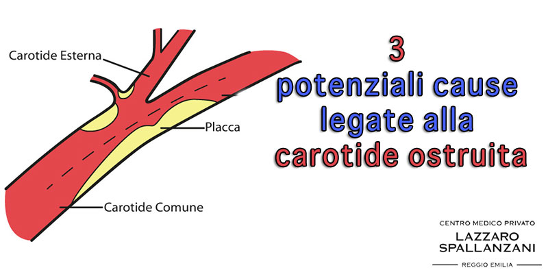 3 potenziali cause legate alla carotide ostruita