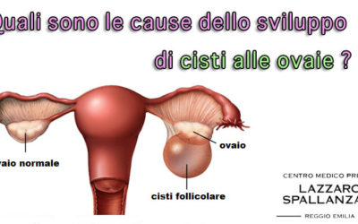 Quali sono le cause dello sviluppo di cisti alle ovaie