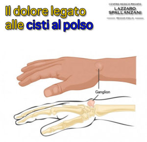 cisti al polso