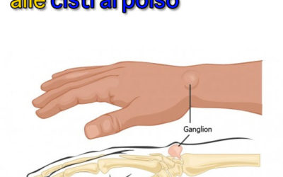 Il dolore legato alle cisti al polso