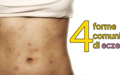 4 forme comuni di eczema