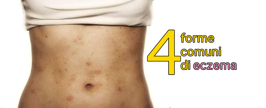 4 forme comuni di eczema