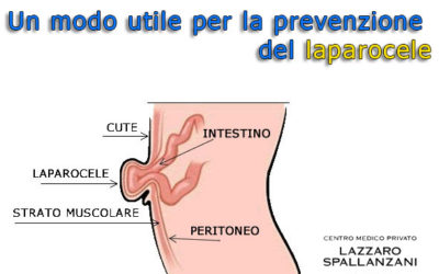 Un modo utile per la prevenzione del laparocele