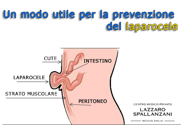 Un modo utile per la prevenzione del laparocele