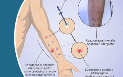 Test allergologici: quando fare il Prick by prick test