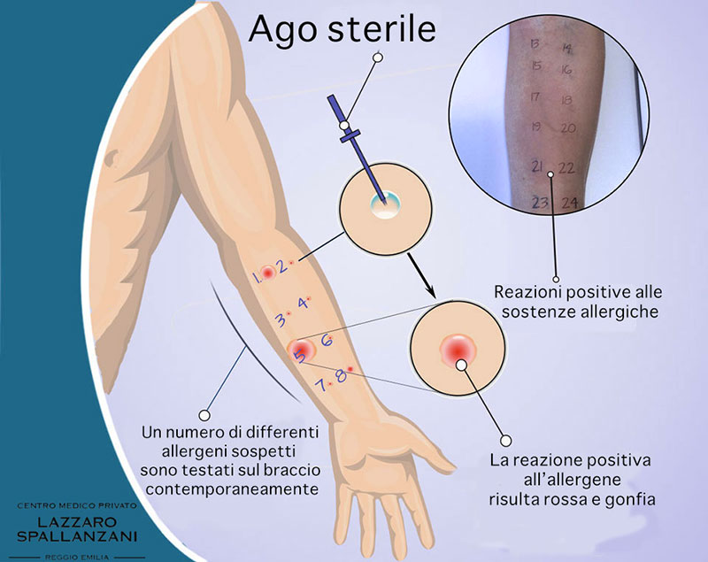 Test allergologici: quando fare il Prick by prick test