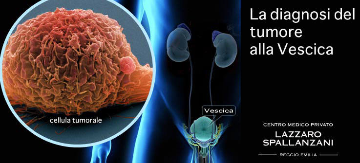 La diagnosi del tumore alla vescica