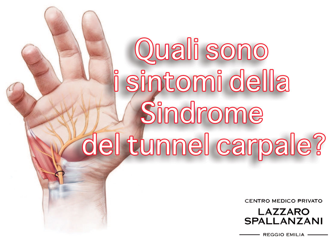Tunnel Carpale quali sintomi dobbiamo tenere sotto controllo?