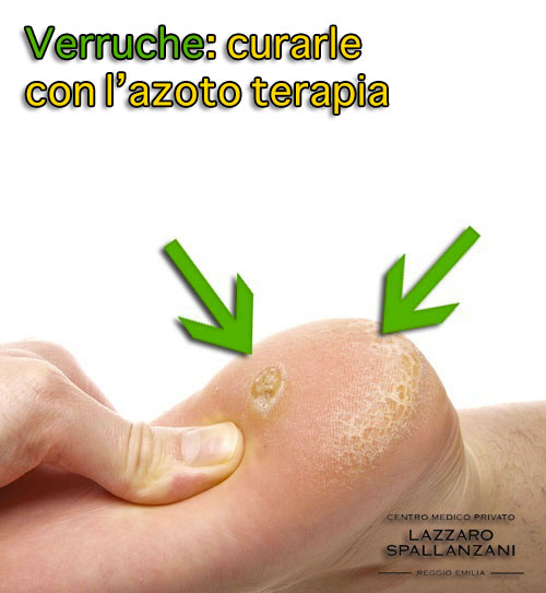 Curare le verruche con l’azoto liquido