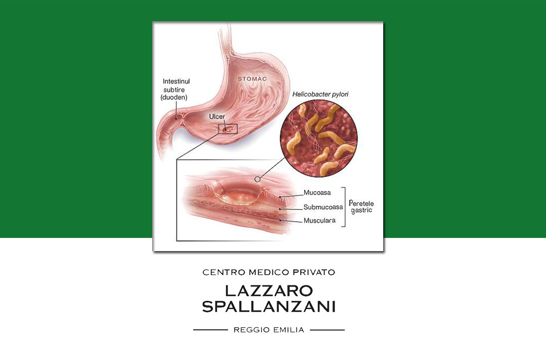 L’efficacia del Test Helicobacter per la gastrite