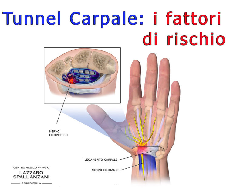 forum post intervento tunnel carpale