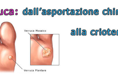 Verruca: dall’asportazione chirurgica alla crioterapia