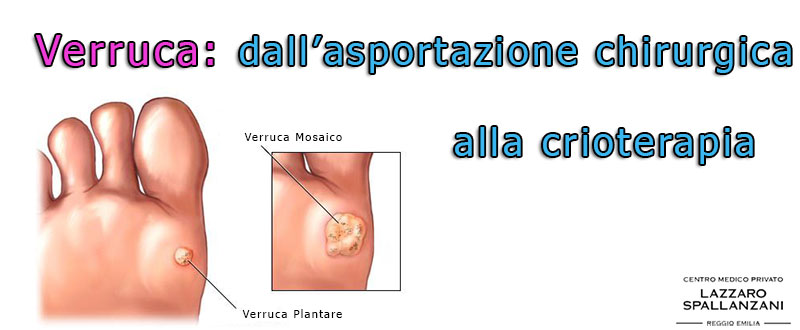 Verruca: dall’asportazione chirurgica alla crioterapia