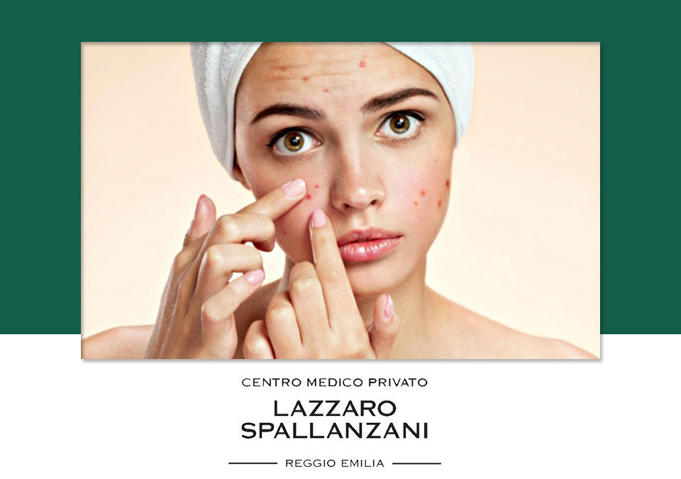 Alcune cause alla base dei problemi di acne