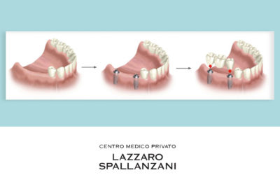 Quali problemi ai denti può risolvere l’implantologia