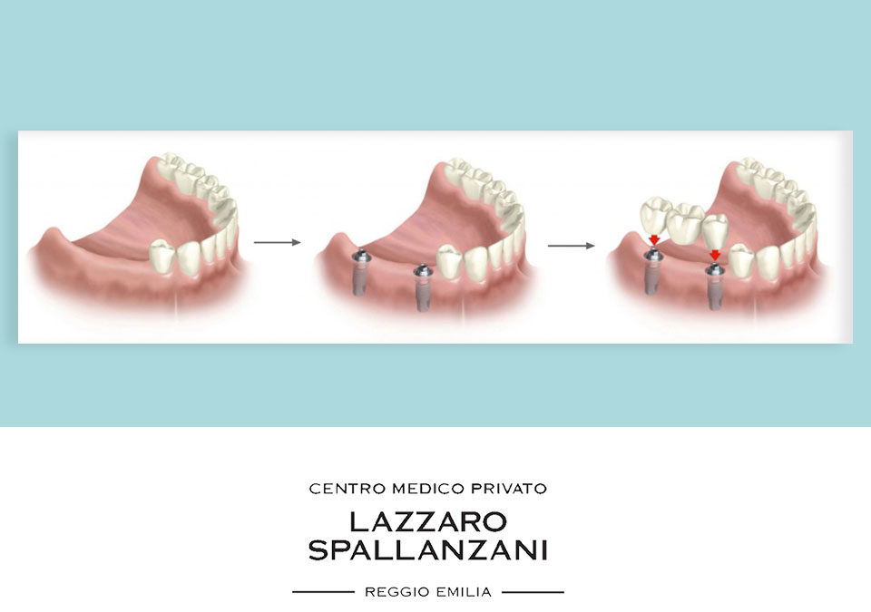 Quali problemi ai denti può risolvere l’implantologia