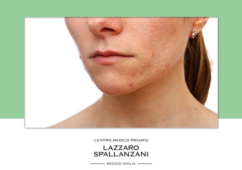 Alcuni metodi per prevenire l’acne cistica