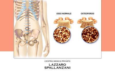 Osteoporosi: l’impatto in Italia e le terapie efficaci per la cura