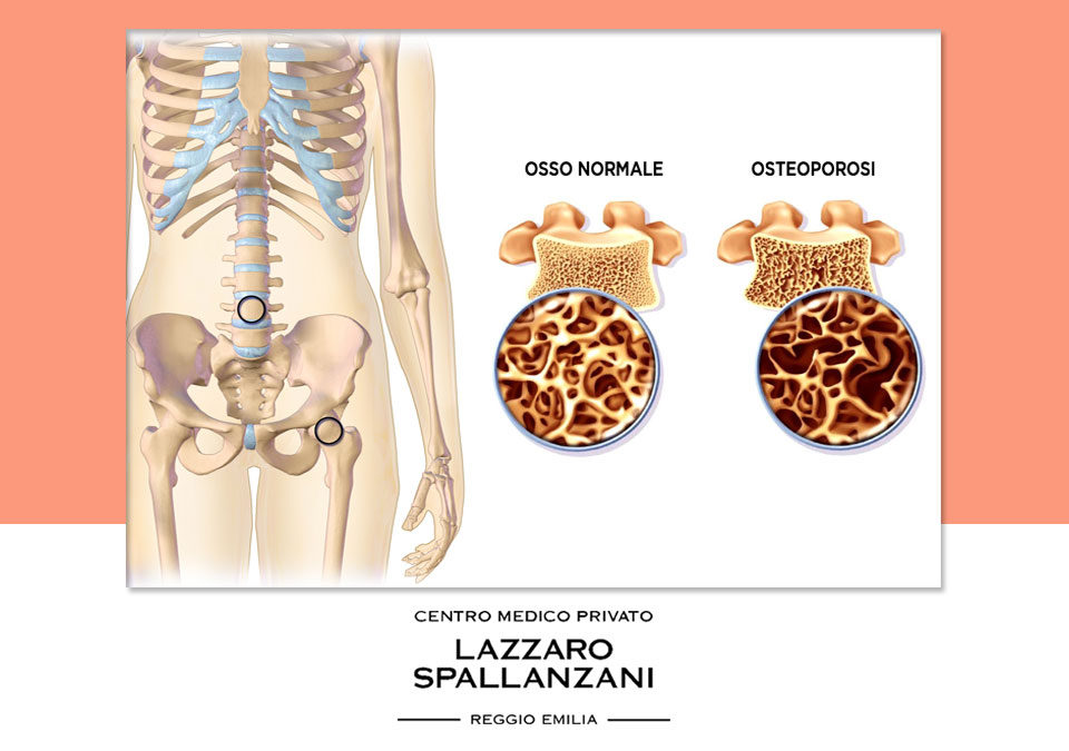 Osteoporosi: l’impatto in Italia e le terapie efficaci per la cura