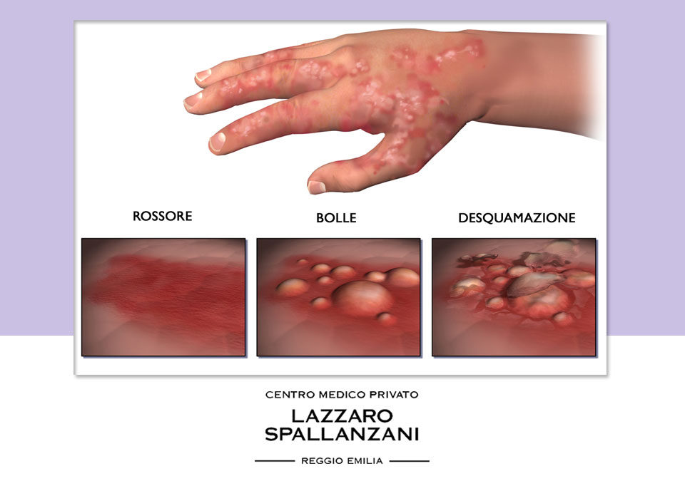 Eczema: ecco alcuni comportamenti da favorire