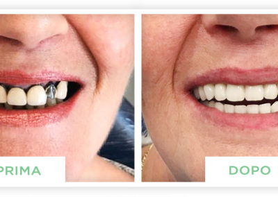 prime e dopo implantologia dentale lazzaro spallanzani reggio emilia 1