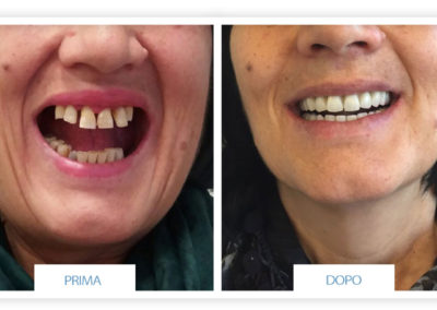 prime e dopo implantologia dentale lazzaro spallanzani reggio emilia 10