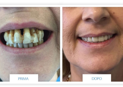 prime e dopo implantologia dentale lazzaro spallanzani reggio emilia 9
