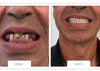 prime e dopo implantologia dentale lazzaro spallanzani reggio emilia 8