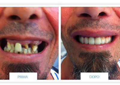 prime e dopo implantologia dentale lazzaro spallanzani reggio emilia 7