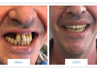 prime e dopo implantologia dentale lazzaro spallanzani reggio emilia 6