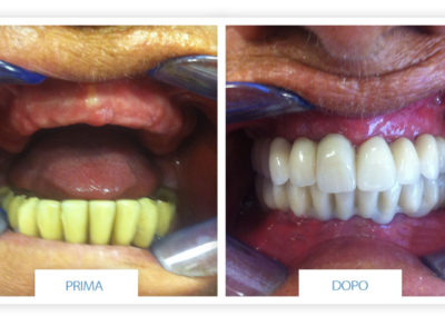 prime e dopo implantologia dentale lazzaro spallanzani reggio emilia 5