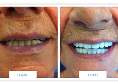 prime e dopo implantologia dentale lazzaro spallanzani reggio emilia 4
