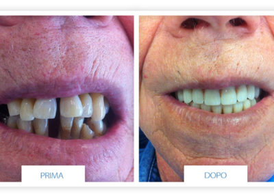 prime e dopo implantologia dentale lazzaro spallanzani reggio emilia 3