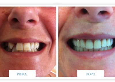 prime e dopo implantologia dentale lazzaro spallanzani reggio emilia 2