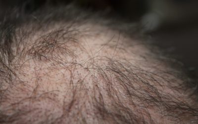 Alopecia: sintomi e cause