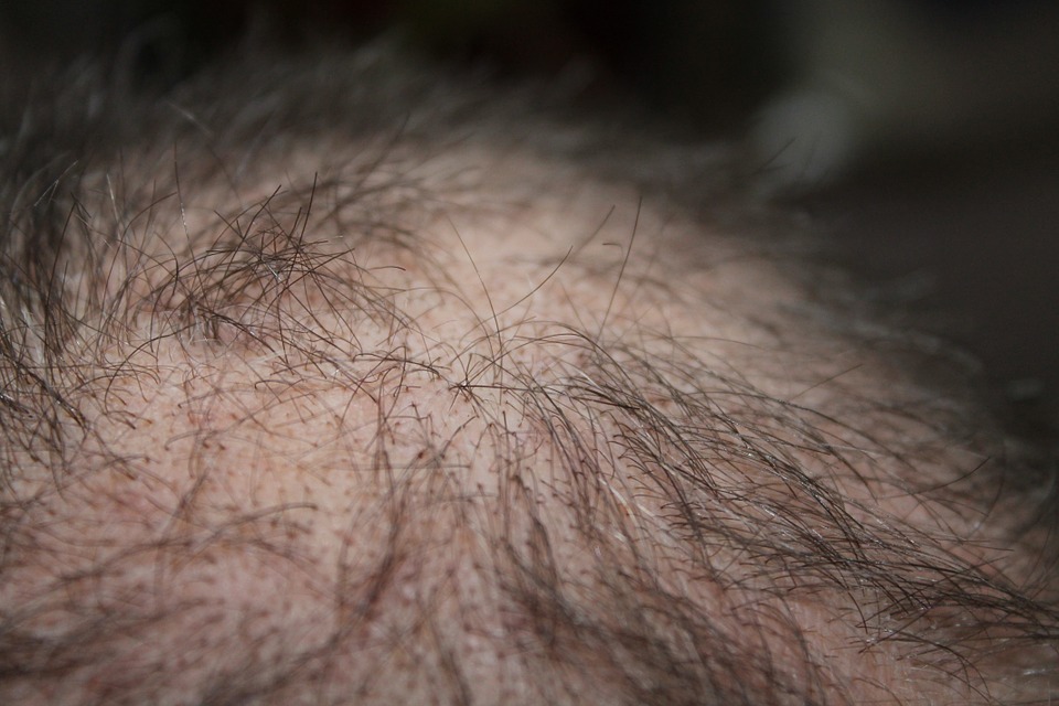 Alopecia: sintomi e cause