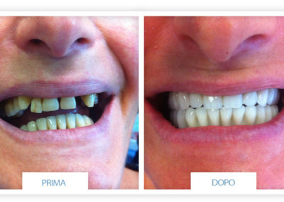 denti prima e dopo