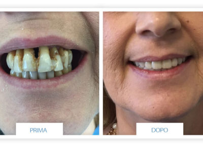 denti prima e dopo