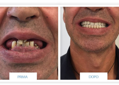 denti prima e dopo
