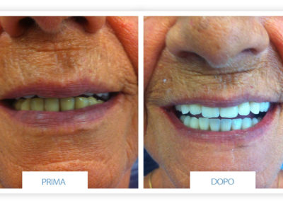 denti prima e dopo