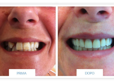 denti prima e dopo