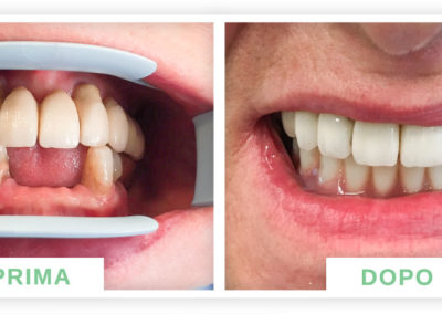 denti prima e dopo